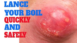 lancing a boil | How To Actually lance a boil | Pop cyst | Infectious skin warts