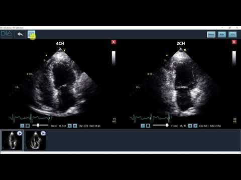 LVivo EF - AI based analysis for Ejection Fraction  logo