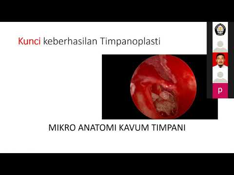 Faktor Keberhasilan Timpanoplasti