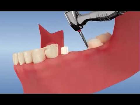 Le bridge dentaire, c’est quoi ?