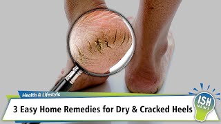 3 Easy Home Remedies for Dry & Cracked Heels