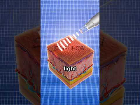 How Tattoos Are Removed 😱