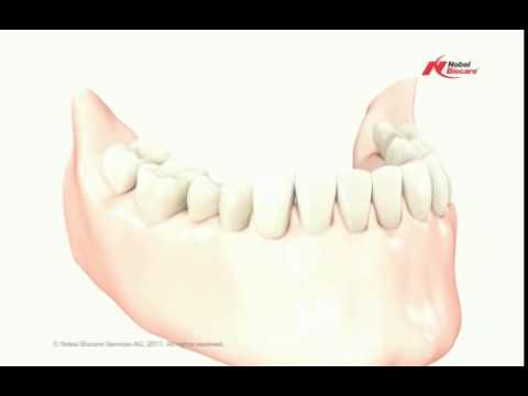 Brücke auf natürlichen Zähnen