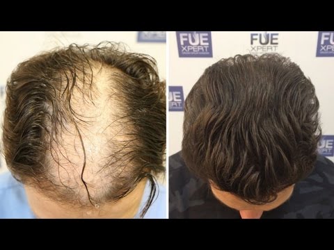 FUE Hair Transplant (4200 grafts in Advanced Female Pattern) by Dr. Juan Couto - FUEXPERT CLINIC