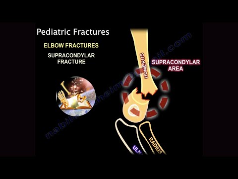 Fractures Supra-condyliennes Pédiatriques de l'Humérus - Tout ce que vous devez savoir - Dr Nabil Ebraheim