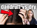 Distinguishing Dandruff From Dry Scalp Expert Tips For Clearing Up Flakes