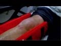 Shattered Knee Part 1 Bizarre ER