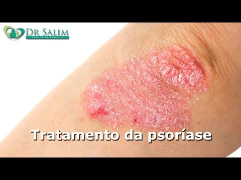 Repolho no momento de tratamento de eczema Do que tratar a psoríase em uniões