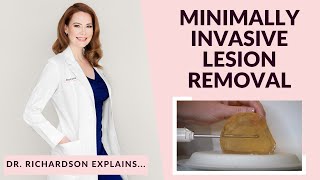 Can We Remove A Benign Breast Lump Without Surgery? Yes. Dr. Richardson Explains!