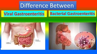 Distinction between Viral Gastroenteritis and  Bacterial Gastroenteritis