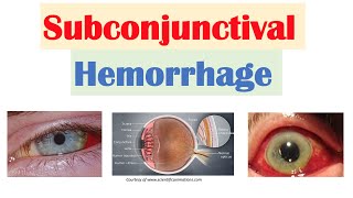 Subconjunctival Hemorrhage (Blood in Eye) | Causes, Signs & Symptoms, Diagnosis, Treatment