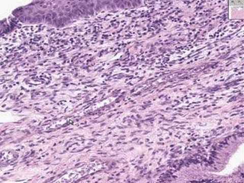 Aspen corteccia proprietà medicinali della prostata Adenoma prostatico Omeopatia