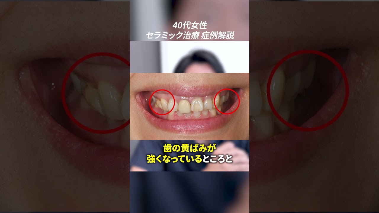 歯の黄ばみや歯並びをきれいにしたい40代女性のセラミックビフォーアフター付き症例解説