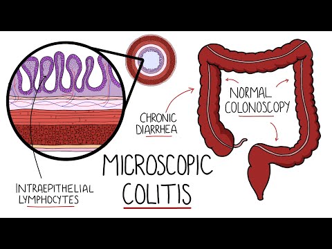 Understanding Wilson s Disease Hepatolenticular Degeneration