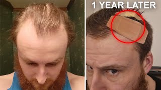 1 Year On - How I Reversed My Receding Hairline Update