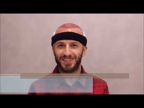 Резултат след трансплантация на коса в Турция – Turhair клиника