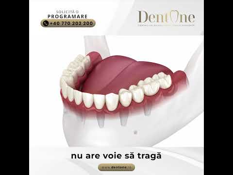 Amprenta pe implanturi: cheia succesului lucrării finale