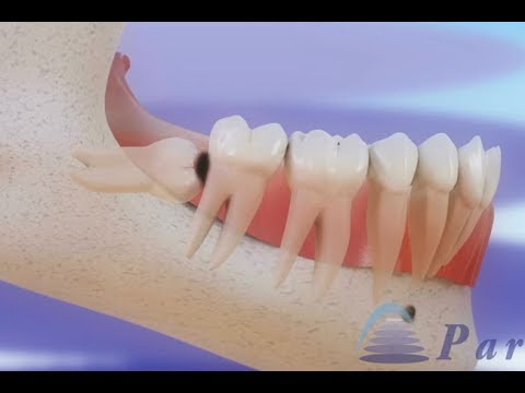 पेरिकोरोनराइटिस (Wisdom teeth removal) ©