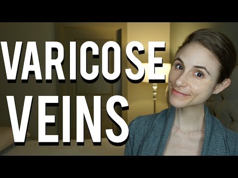 Varicose and spider vein treatment| Dr Dray 🕸