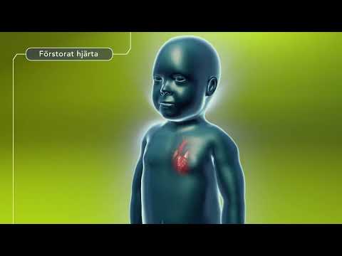 Pompes sjukdom (Swedish)