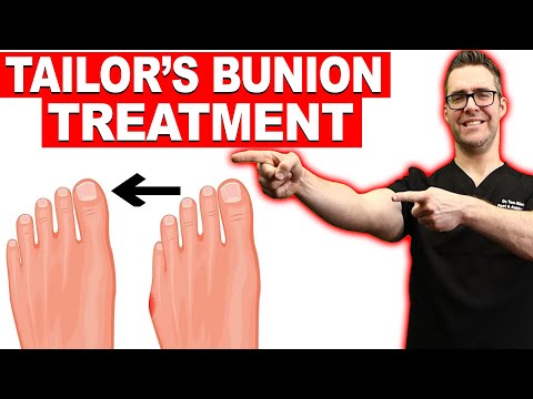 , title : '#1 Tailor's Bunion & Bunionette Treatment? [Correctors? Surgery?]'