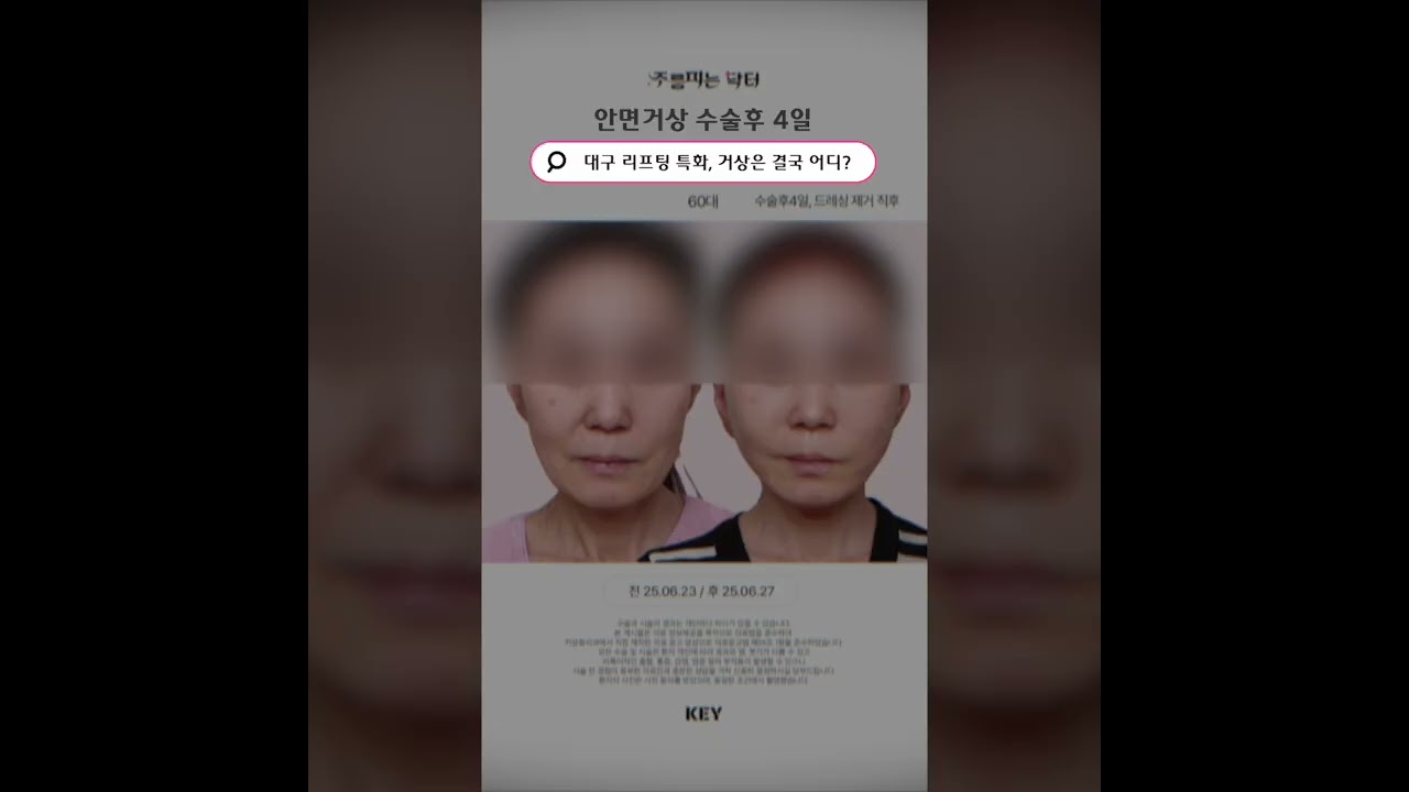 안면거상 수술후4일, 한달 회복과정