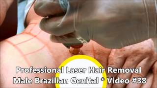Professional Laser Hair Removal - Male Brazilian genital - Video #38