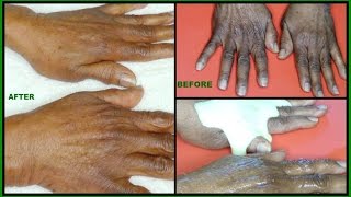 HOW TO CARE FOR AGING HANDS, GET RID OF WRINKLES  SAGGING HANDS| 92 YEARS OLD HANDS |Khichi Beauty