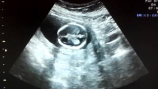 preview picture of video '15 Week Ultrasound -Baby Gender Reveal!'