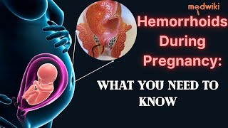 Hemorrhoids During Pregnancy: What You Need to Know