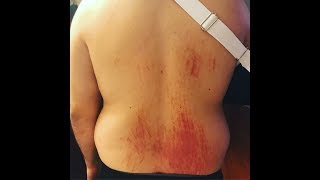 Why I Haven't Been Active (Boosted Board Accident)