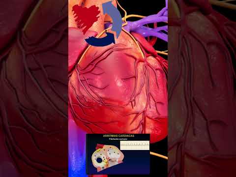 Qué es la fibrilación auricular