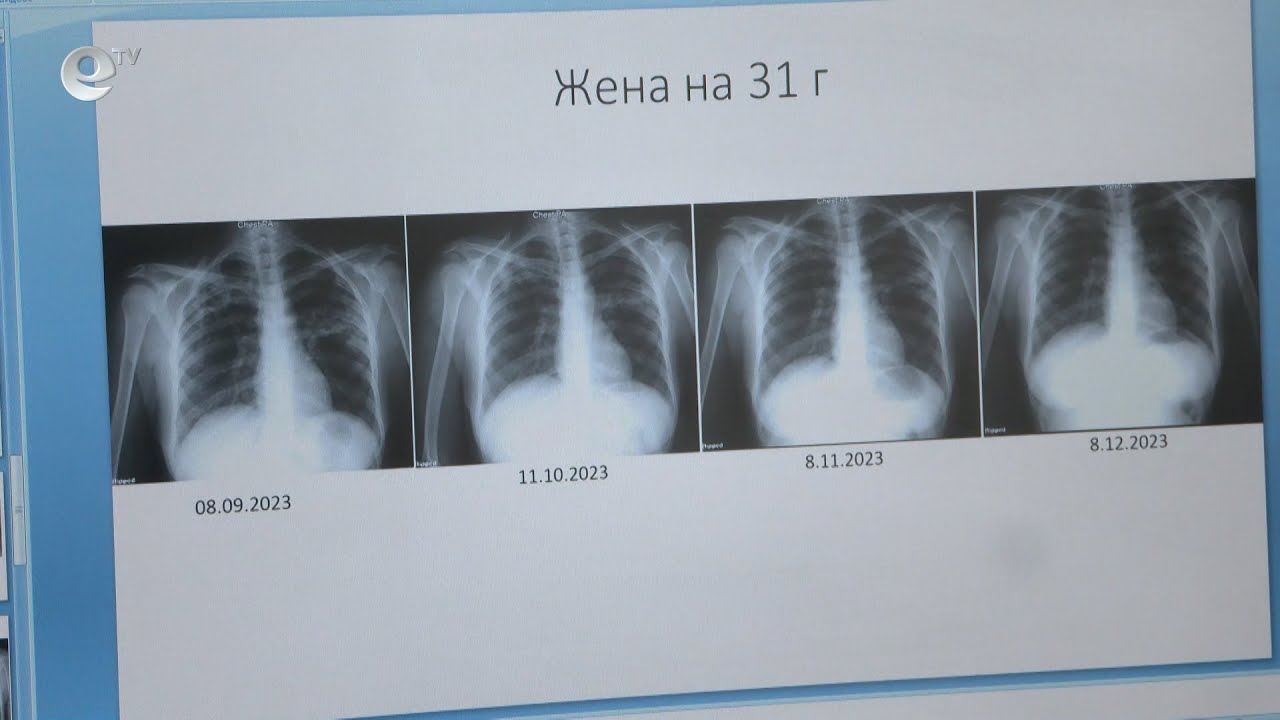 Стартират безплатни прегледи за туберкулоза в област Хасково