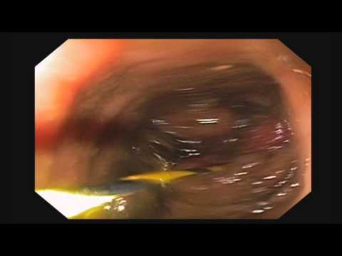Stent Placement for Obstructing Colon Cancer