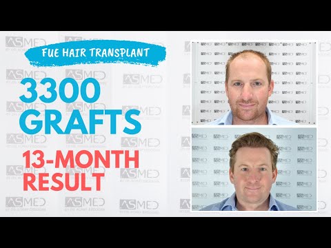 Manual FUE Hair Transplant Before & After 3300 Grafts 13-Month Result - ASMED - Dr. Koray Erdogan