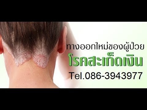 โรคสะเก็ดเงินความคิดเห็นของเอลตัน ซักผ้า neurodermatitis