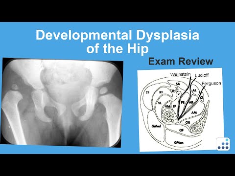 Developmental Dysplasia of the Hip Exam Review - William Jiranek, MD
