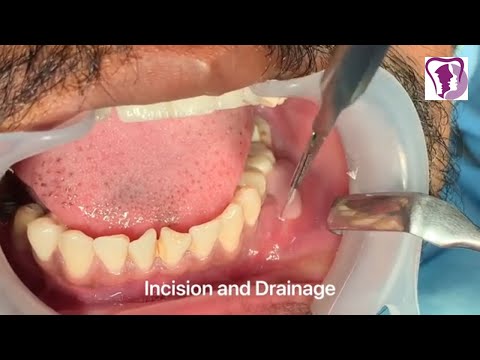 Incision and Drainage of Tooth Abscess Draining Pus