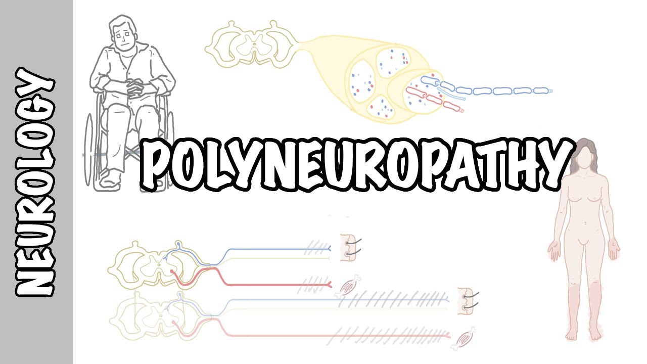 Approach to Polyneuropathy - causes, pathophysiology, investigations