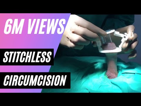 Adult Circumcision Aliskamp by Dr Rizwan Khan,  Pune,  Mumbai,  India, Phimosis Foreskin treatment