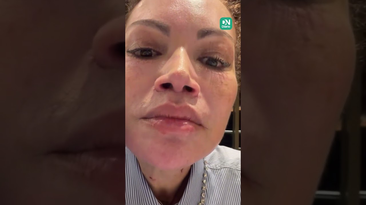 Imagem da notícia Solange Almeida faz cirurgia de rejuvenescimento facial; veja primeiros resultados