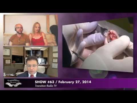 Facial Feminization Surgery Ffs In Florida