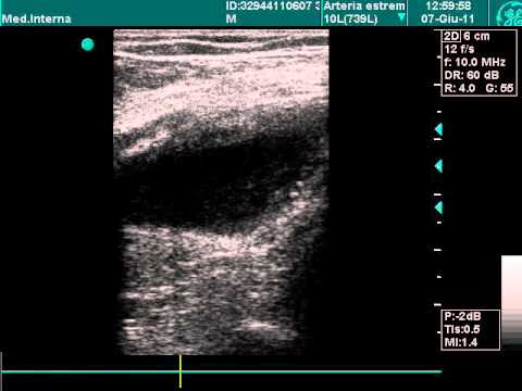 Popliteal Aneurysm In Doppler Exam