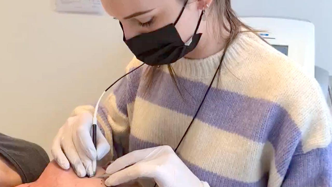 Electrolysis hair removal for transgender women - 2pass Clinic Electrolysis hair removal for transgender women - 2pass Clinic