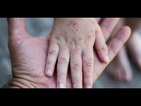 Nuevos casos de sarampión en Paraguay