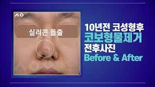 [시우 전후사진] 코보형물제거_10년전 코성형 후 제거 /실리콘돌출