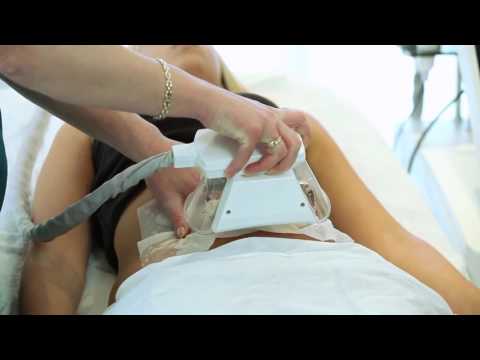 3D Ultimate /Lipo /HIFU/Tightening/Cellulite/Facelift  Video