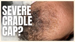 TRY THIS FOR SEVERE RECURRING CRADLE CAP! | Brittney Gray