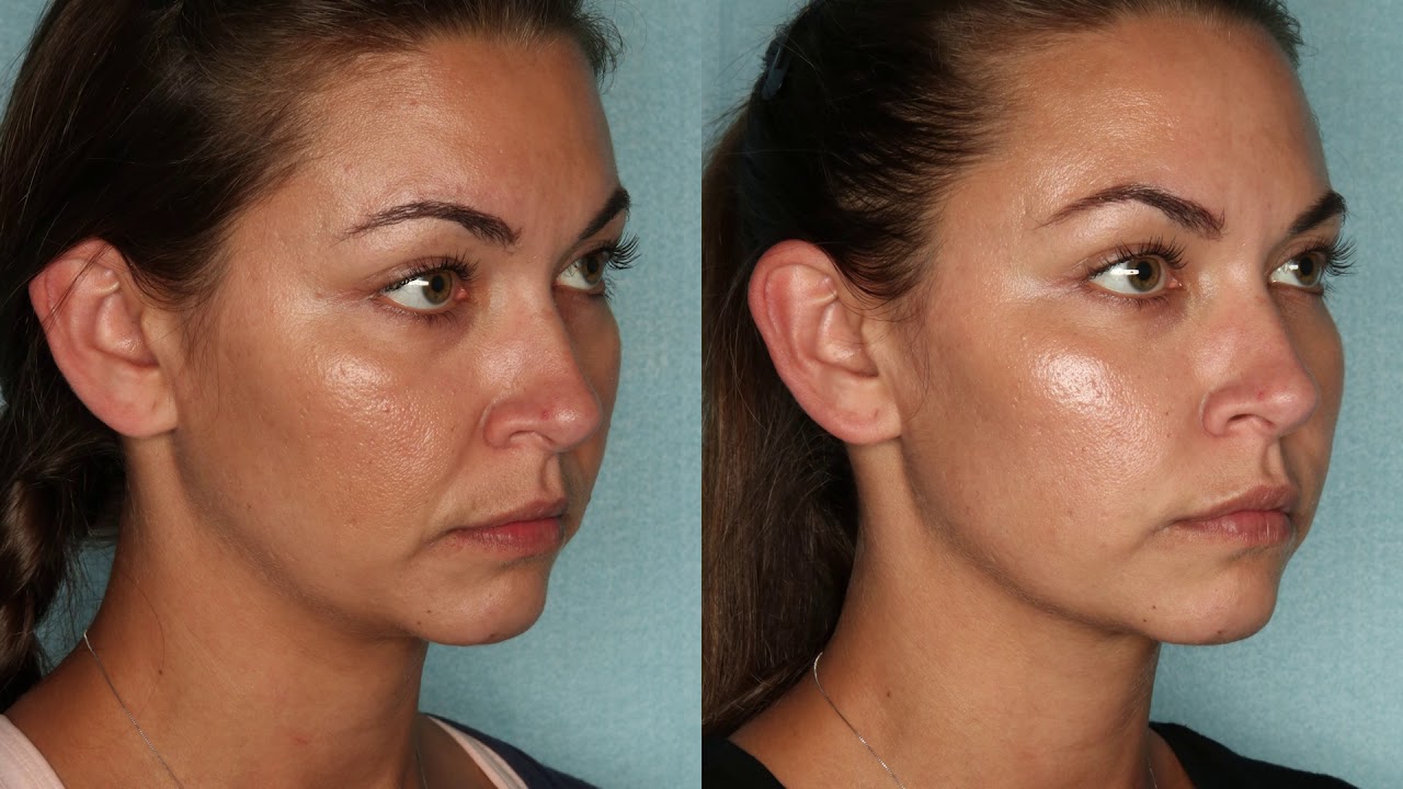 Dr Kiran Gill Patient Videos Cosmetic Plastic Surgery Naples Florida