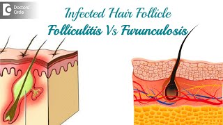 Infected hair follicle. What to do? Causes, Location, & Treatment-Dr. Rasya Dixit | Doctors
